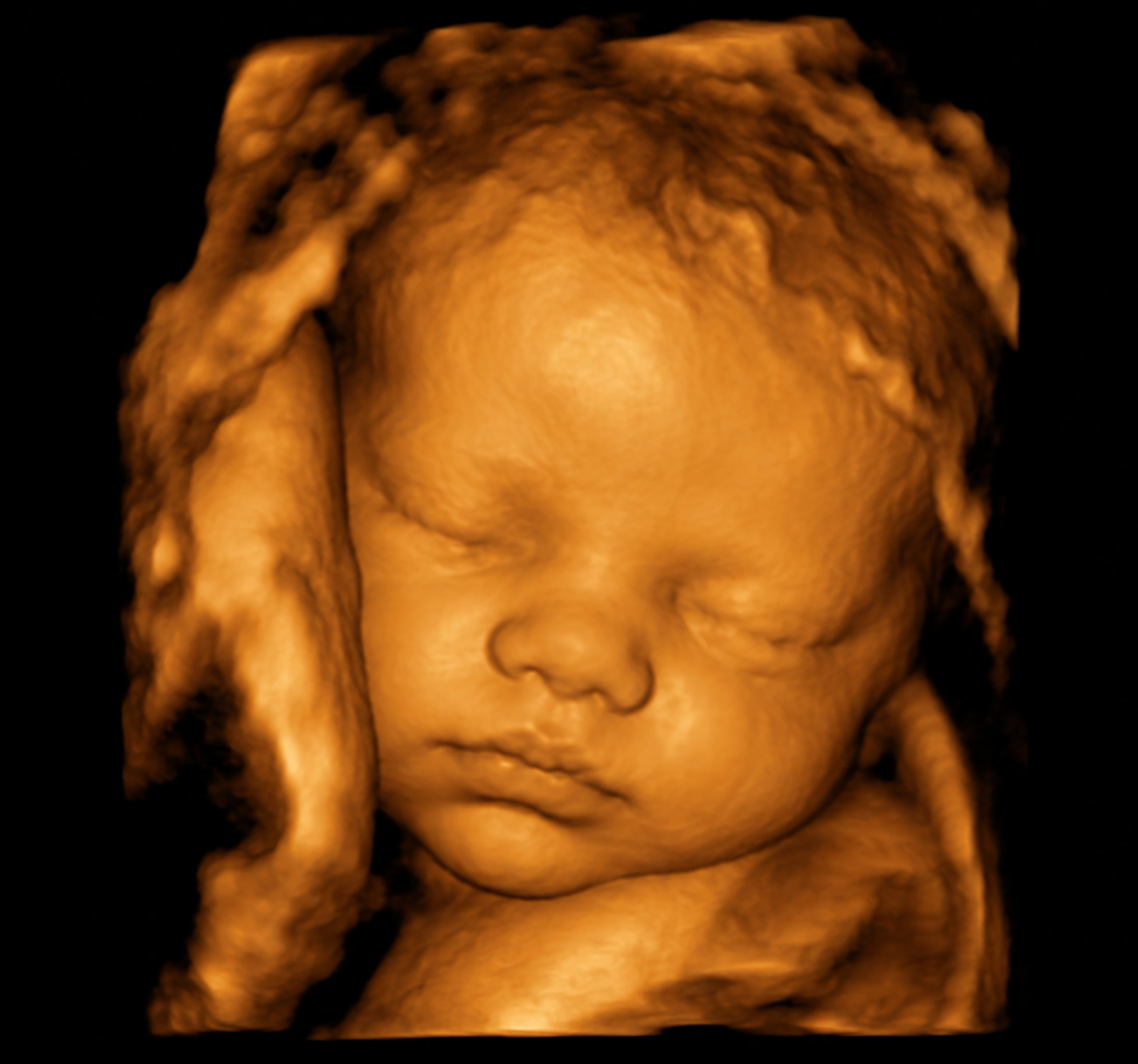 3D Baby Ultrasound